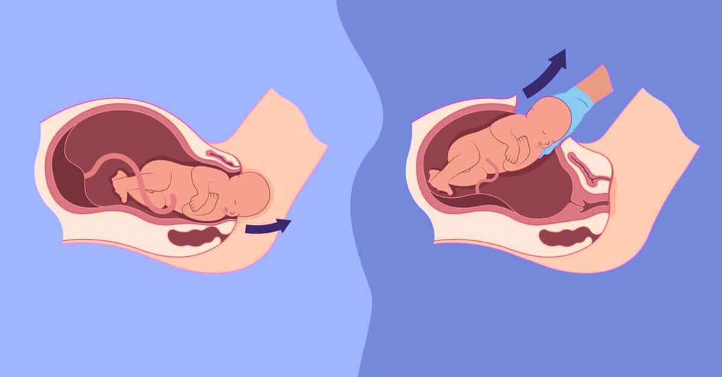 Normal Birth vs. C-Section