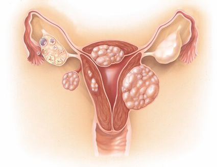 Uterine Fibroids