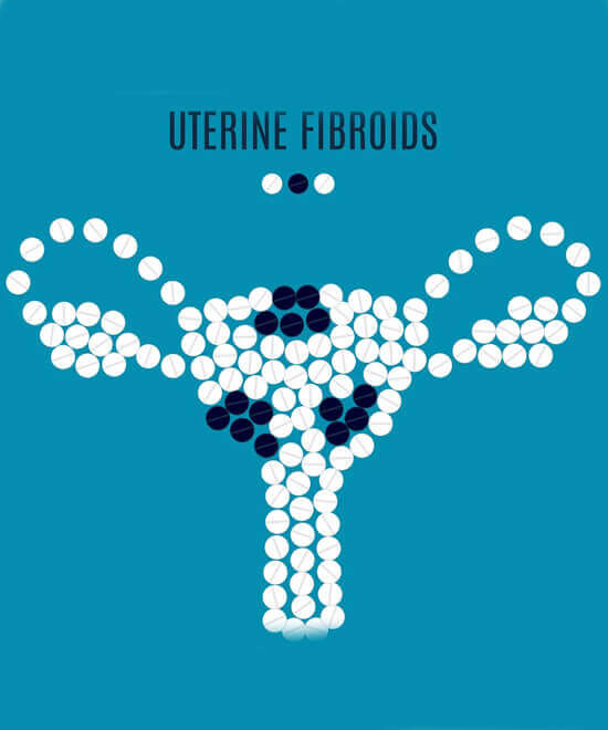 Best Doctor for PCOS and Uterine Fibroids In Hyderabad