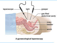 Laparoscopic Myomectomy