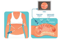 Laparoscopic Myomectomy
