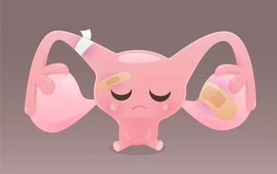 Laparoscopic Ovarian Cystectomy