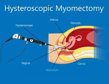 Hysteroscopic Myomectomy
