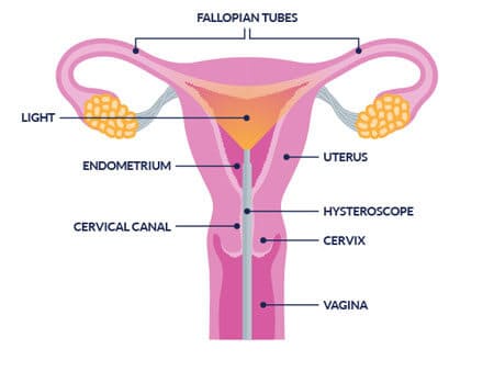 Hysteroscopic Myomectomy