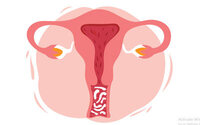 Vaginal Hysterectomy